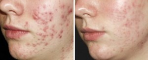 acne huid peeling