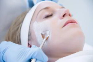Acne behandeling steenwijk Medische peeling